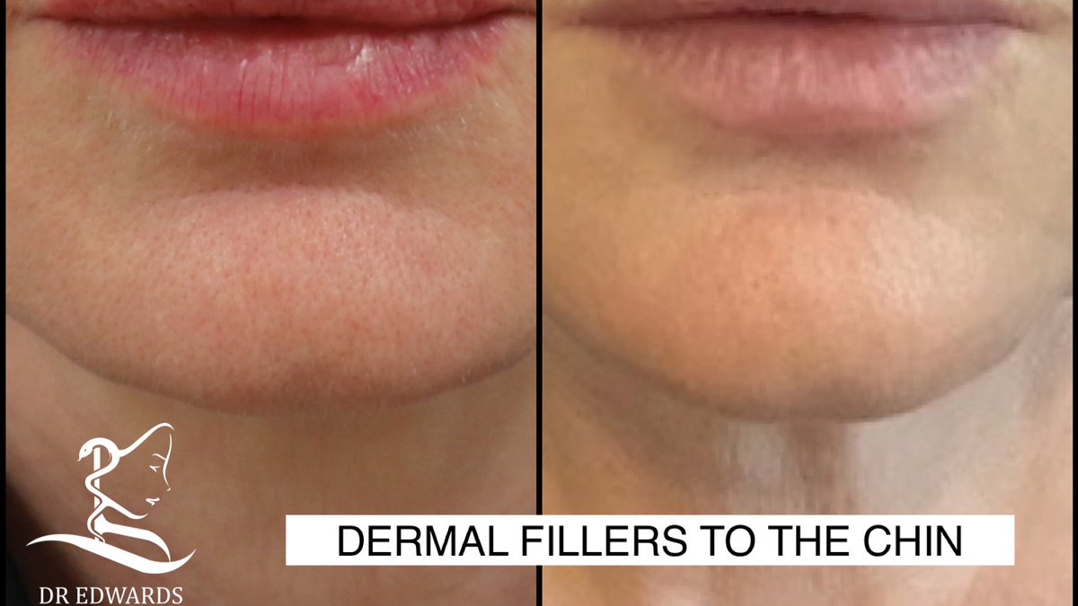 For those of us with a recessive, small or poorly defined #chin fillers add volume and shape enhancing the proportions of the profile of the face. <a href="/DrREdwards/">Richard Edwards</a> adding definition to the contours of the face to allow for either a more feminine or masculine look depending on the aim.