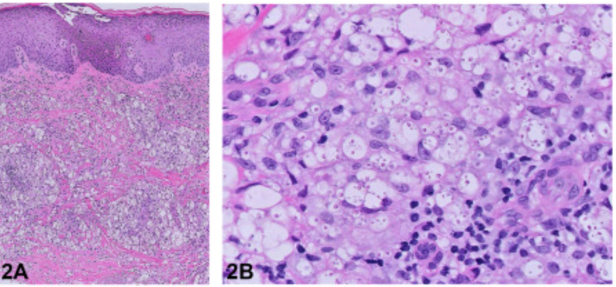What's your #diagnosis? Solitary leg ulcer in a renal transplant recipient Answer at jaadcasereports.org/article/S2352-… #dermatology #pathology #dermtwitter #PathTwitter <a href="/JAADjournals/">JAAD Journals</a>