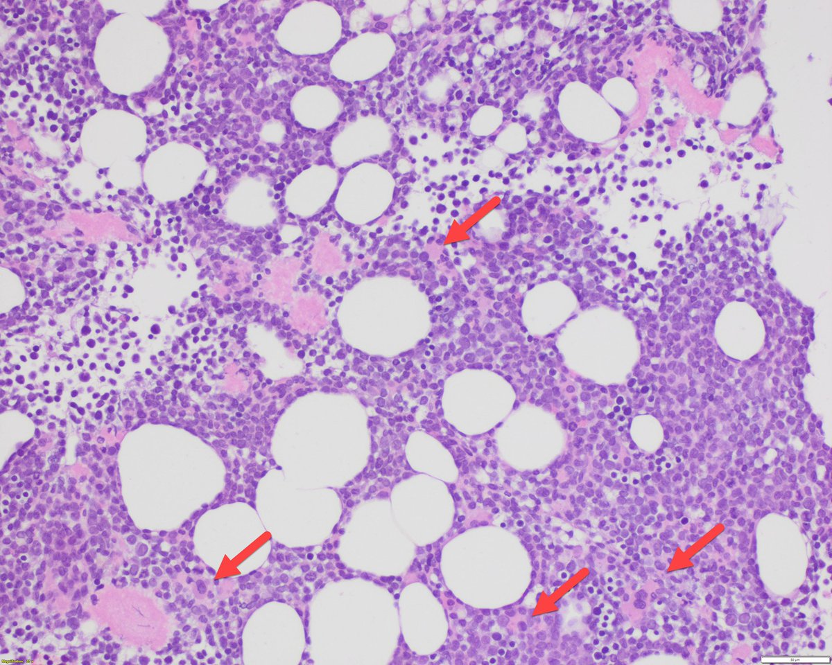 Sanam Loghavi, MD صنم لغوی 🔬🧬 tweet media