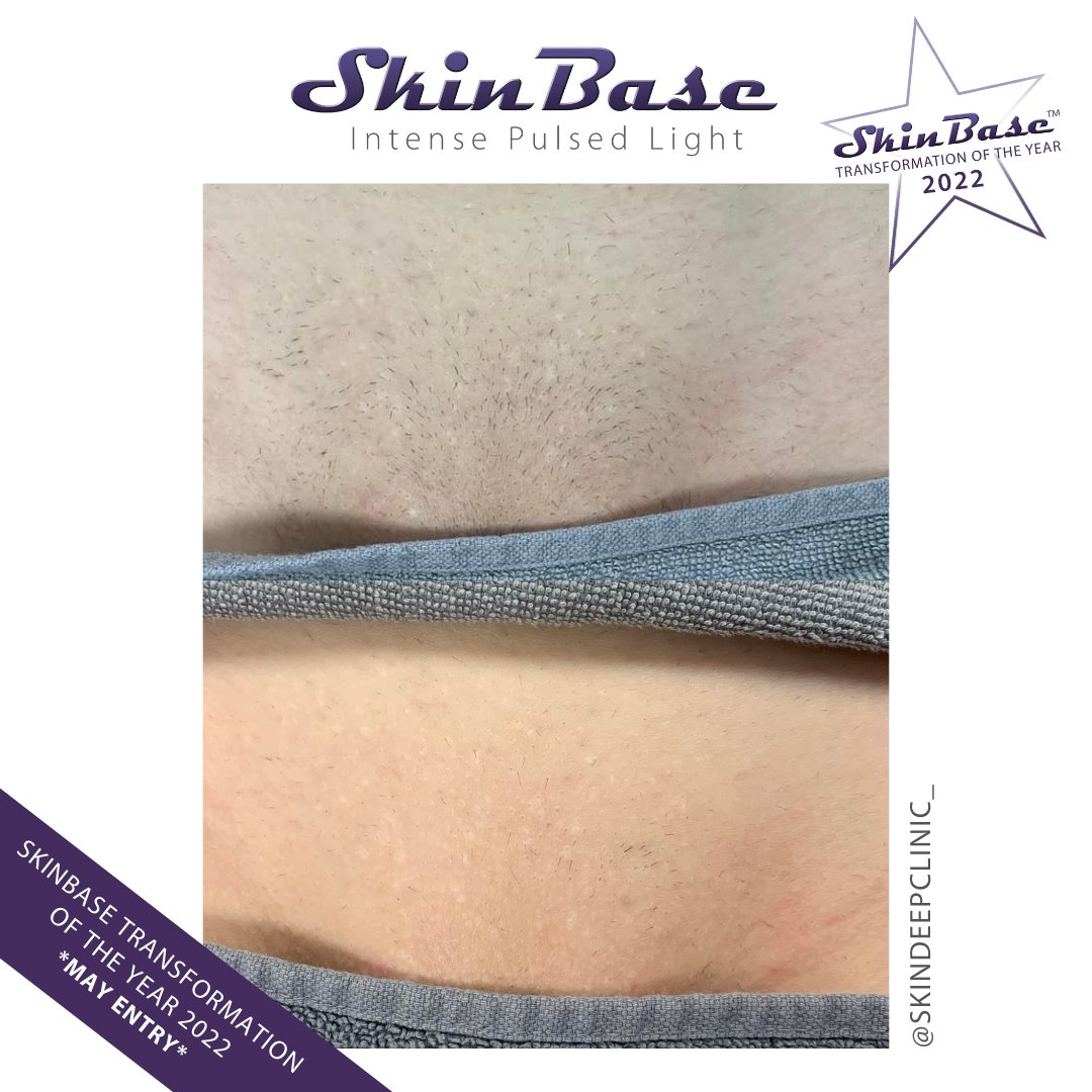 SkinBase_facial's tweet image. ⭐️ May transformation with this fabulous entry from Skin Deep Clinic. These fantastic results were achieved through a treatment course of IPL Hair Reduction.  

Click the link in our bio for your chance to Win a Holiday! #skinbase #skinbaseipl #transformation22