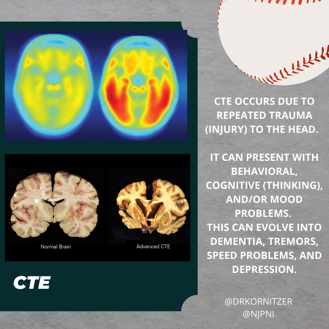 NJCraniofacial's tweet photo. Did you know Ryan Freel was the first Major League Baseball player diagnosed with chronic traumatic encephalopathy (CLE)?

#neurology #baseball #baseballcards #baseballlife #concussion #cte #braintrauma #childneurology  #neurosurgery #ryanfreel #sportsmedicine #neuroscience https://t.co/b283IVuAIX