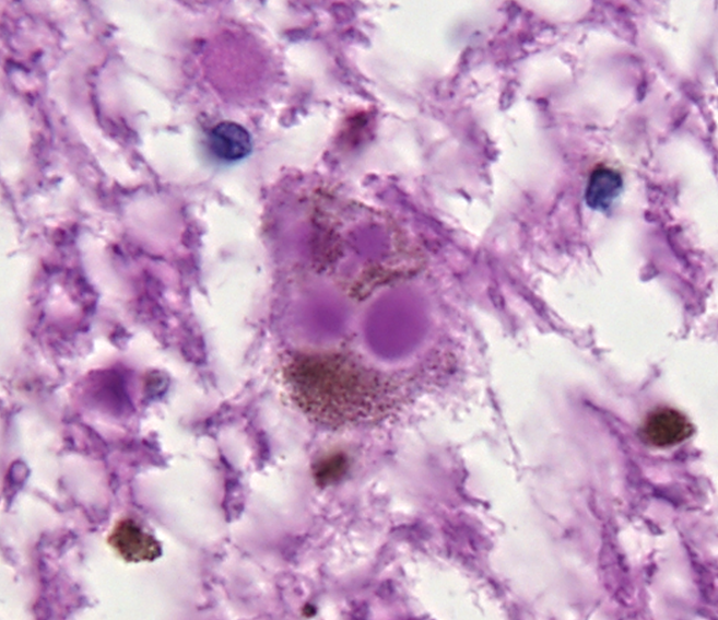 Nigral neurons overtaken by Lewy bodies