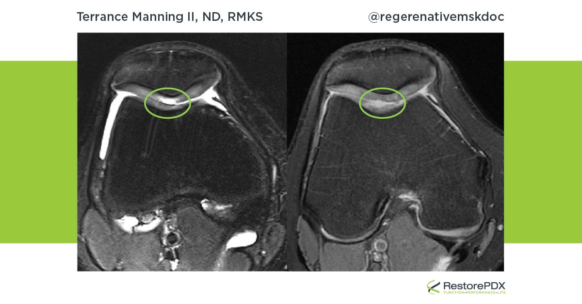 The first image shows an initial MRI pretreatment compared to a post-treatment scan 18 months later. This cartilage is now at full thickness and healed. Find out if regenerative medicine is right for you and the treatment options available at RestorePDX.  restorepdx.com