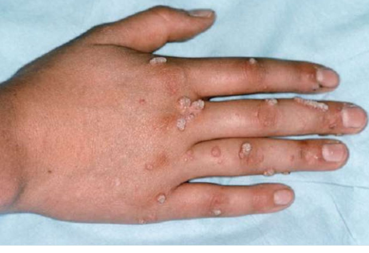 2. أعراض #جدري_القرود تظهر علي هيئة حمى وتضخم في الغدد الليمفاوية وآلام في العضلات، مع الإرهاق والقشعريرة وطفح جلدي يشبه جدري الماء على اليدين والوجه أولا، وهو مرض نادر وتأثيراته خطيرة، وظهرت عشرات الحالات في بريطانيا، أسبانيا، البرتغال،#أمريكا بين شاذين جنسيا! #كلنا_ادريس_غانا