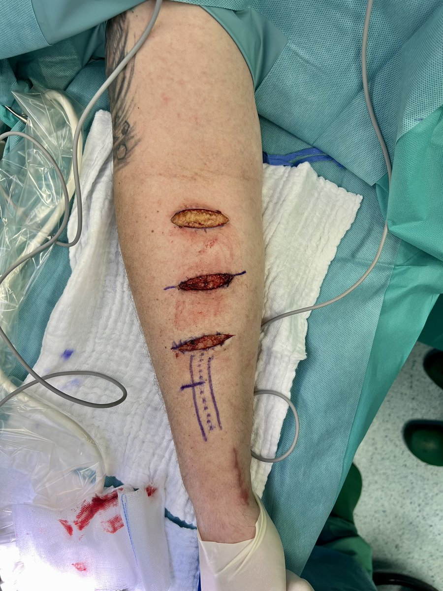 robshahverdyan's tweet photo. @wasse_m and this is how I do my (mostly forearm, if there are any - upper arm) cephalic vein elevation procedures by a lipectomy at 6-8 weeks w transverse incisions (learned from Karl Illig) &amp; leaving the vein undisturbed with branches. 6w/o mature #RCAVF ready to stick #ESKD https://t.co/M8CyN7fgle