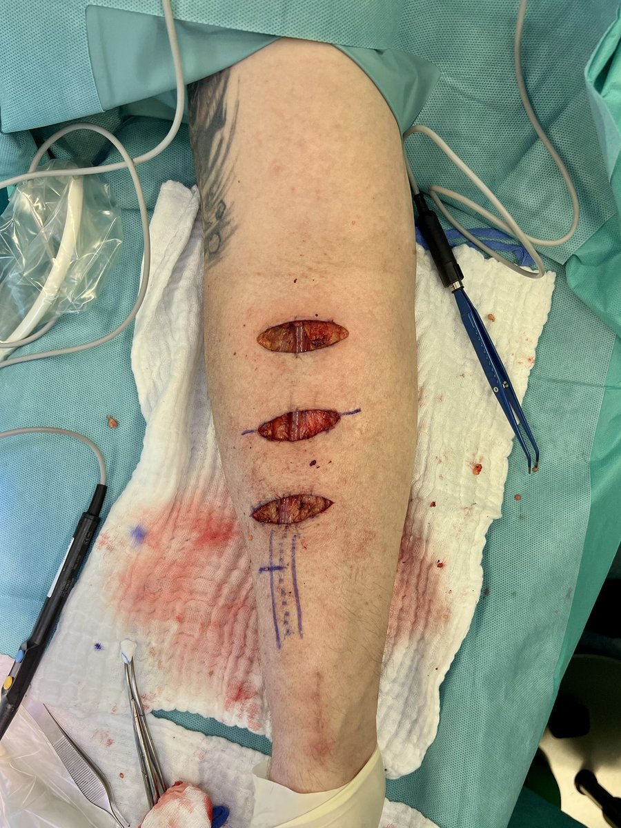 robshahverdyan's tweet photo. @wasse_m and this is how I do my (mostly forearm, if there are any - upper arm) cephalic vein elevation procedures by a lipectomy at 6-8 weeks w transverse incisions (learned from Karl Illig) &amp; leaving the vein undisturbed with branches. 6w/o mature #RCAVF ready to stick #ESKD https://t.co/M8CyN7fgle