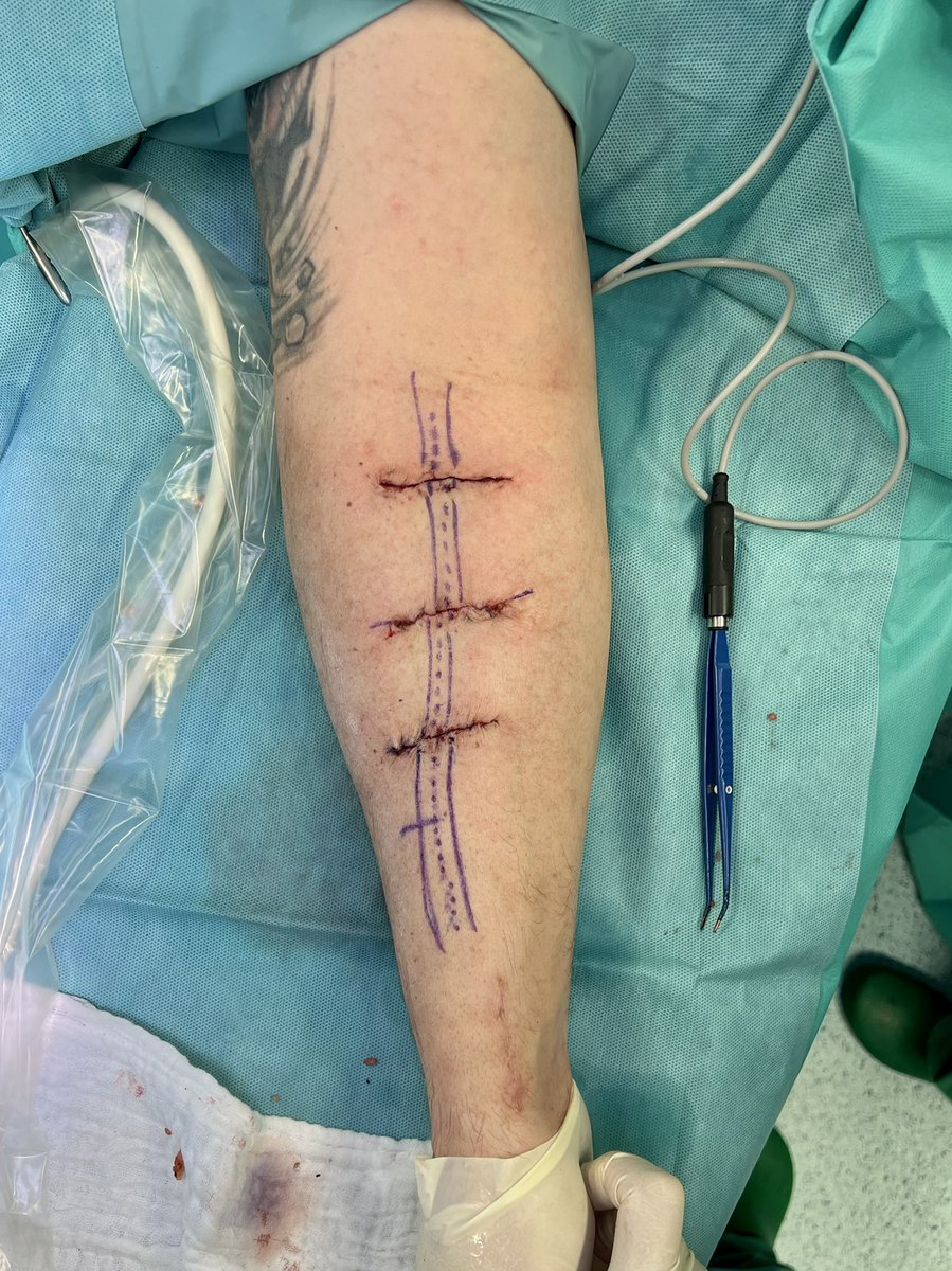 robshahverdyan's tweet photo. @wasse_m and this is how I do my (mostly forearm, if there are any - upper arm) cephalic vein elevation procedures by a lipectomy at 6-8 weeks w transverse incisions (learned from Karl Illig) &amp; leaving the vein undisturbed with branches. 6w/o mature #RCAVF ready to stick #ESKD https://t.co/M8CyN7fgle