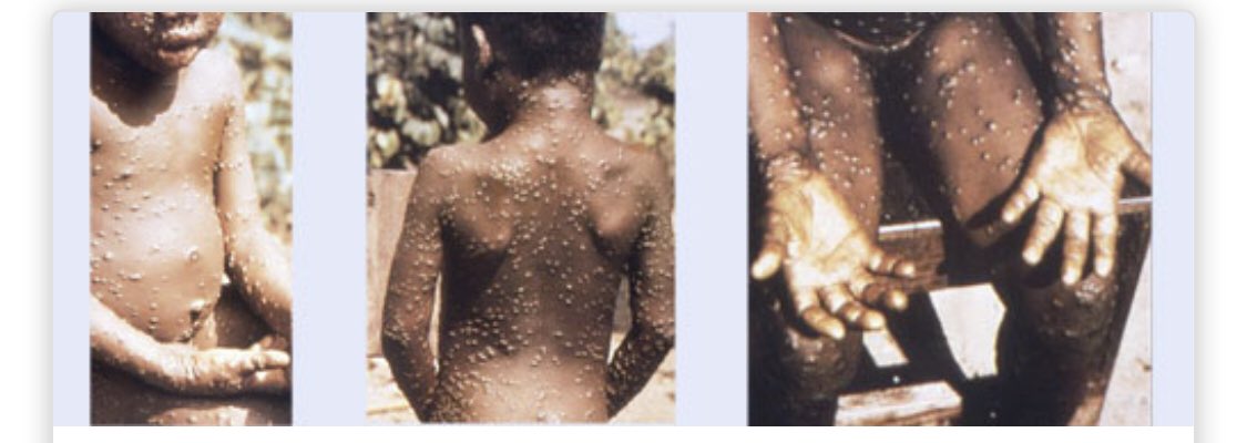 foamid's tweet photo. Summary: Consider #monkeypox in pts w/ typical rash, esp if recent appropriate travel hx. 
Incubation time: 1-3wks
Assoc. sx: f/c, lymphadenopathy —> rash (1-3d later)
DDx: secondary #syphilis, #HZV, #chancroid, #VZV

Photo of rash from @CDCgov 

#FOAMid #Derm #emergencymed https://t.co/NG6Ygz2c62