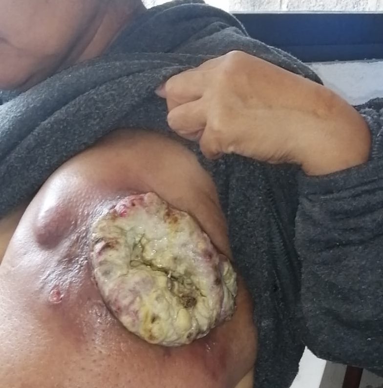 La foto de la izquierda es el seno de Sandra Luz en noviembre del 2021, el de la derecha es de hace unas semanas. Hoy tenía cita en el Hospital General para iniciar con quimio… se la pospusieron, otra vez. Lleva meses sin poder iniciar el tratamiento. <a href="/SSalud_mx/">SALUD México</a>