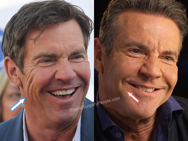 manage weight on X: "Dennis Quaid Before And After Plastic Surgery  https://t.co/ZILZCqS2Lj I had to go deeper before I can say exactly what he  has done. But here's what I have found