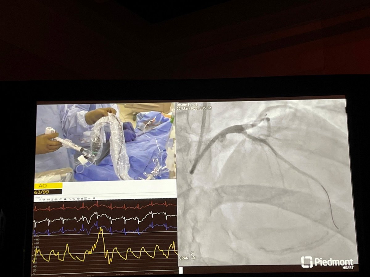 ShockwaveIVL's tweet photo. The experts at @PiedmontHeart showing off in their hometown! Congrats to Drs @KaulP and @Kandzari on an excellent teaching case with #ShockwaveIVL in a mid-prox calcified LAD lesion.
ISI https://t.co/sZ0NdzXNcV #CardioTwitter #ComplexPCI https://t.co/nNIZ3PioRX