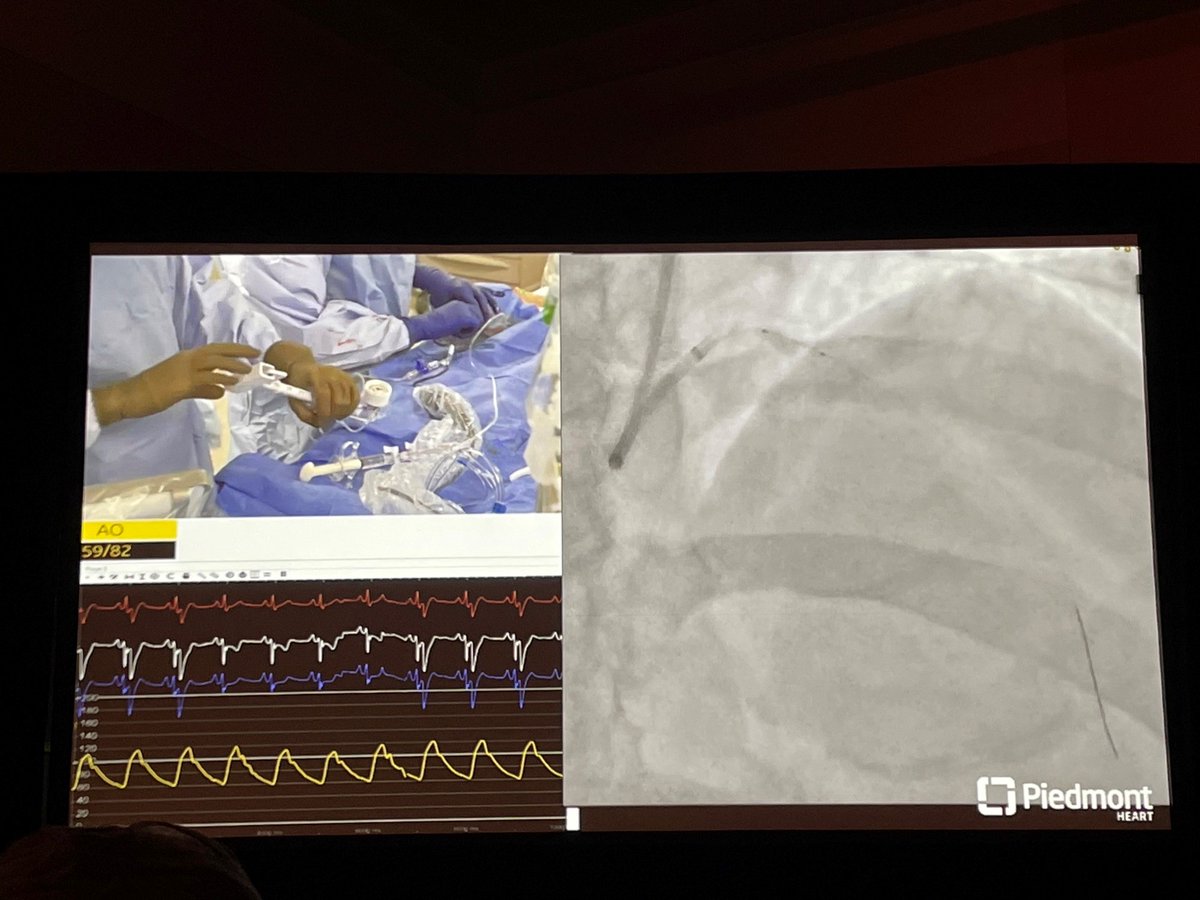 ShockwaveIVL's tweet photo. The experts at @PiedmontHeart showing off in their hometown! Congrats to Drs @KaulP and @Kandzari on an excellent teaching case with #ShockwaveIVL in a mid-prox calcified LAD lesion.
ISI https://t.co/sZ0NdzXNcV #CardioTwitter #ComplexPCI https://t.co/nNIZ3PioRX
