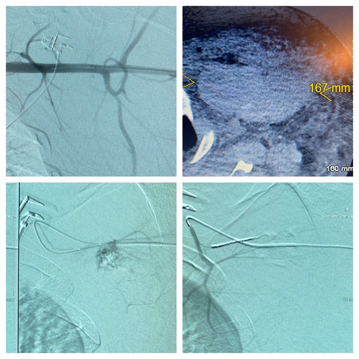 Can’t agree with you more! Just did a case of a patient who was bleeding out into his chest - multiple rounds of blood transfusions. After a transradial embolization of a super selective tertiary axillary branch bleeder - he stabilized. #Loveit