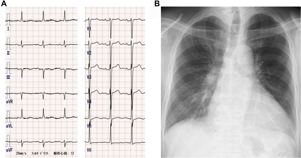 VLSorrellImages's tweet photo. #JADEL #JADIL
@CASEfromASE is more than 'just echo':
"Cardiovascular Imaging" CASE Reports Journal
Check out this wonderful multi-modality imaging report in a 70M with HF & mixed etiology CM.
Read more to learn how each tool helped:
https://t.co/1stN5iT4AS
@ASE360 https://t.co/tdLM9Iskch
