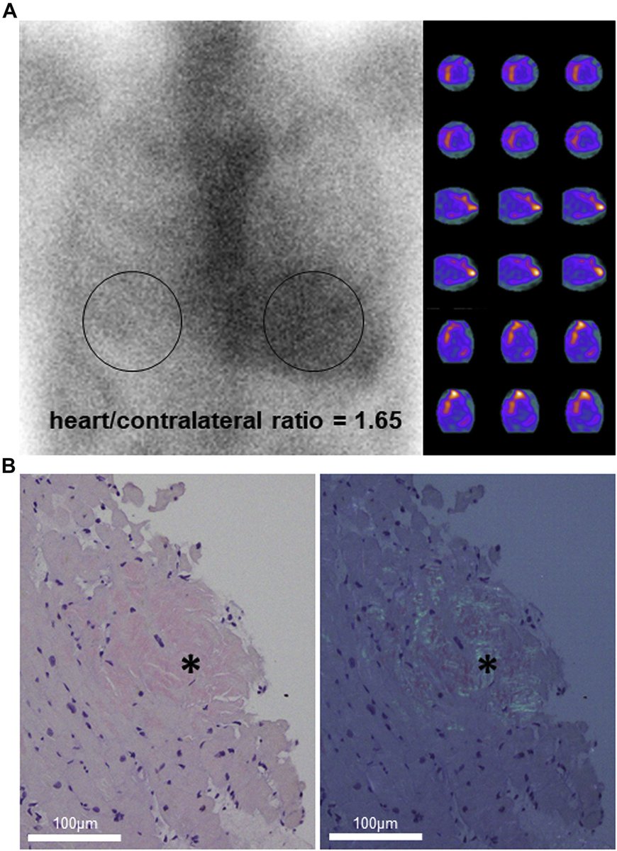 VLSorrellImages's tweet photo. #JADEL #JADIL
@CASEfromASE is more than 'just echo':
"Cardiovascular Imaging" CASE Reports Journal
Check out this wonderful multi-modality imaging report in a 70M with HF & mixed etiology CM.
Read more to learn how each tool helped:
https://t.co/1stN5iT4AS
@ASE360 https://t.co/tdLM9Iskch