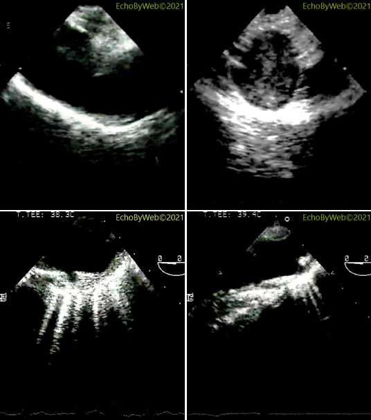 echobyweb's tweet image. Transesophageal assessment of the atherosclerotic lesions of the aorta and Montgomery classification of parietal plaques. In: echobyweb.com/homepage/echo-…
#CardioTwitter #cvImaging #cvEcho #echofirst #cardiology #transesophageal #aorta #atheroma
