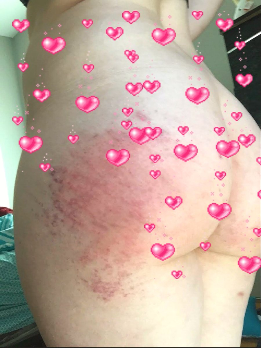GlitxhyBoi's tweet photo. Mightve been too rough this time... #Nsfwtwt #nsfwtwt๏พ #bruisedass #spanks #bdsm #happysexlife https://t.co/5yPH4Tnhwa