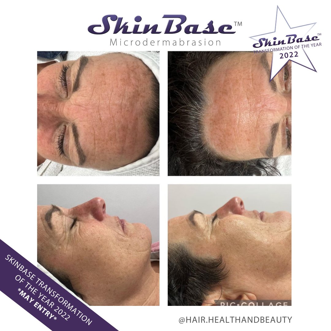 SkinBase_facial's tweet image. ⭐️ May transformation with this fabulous entry from Hair Health &amp;amp; Beauty. These fantastic results were achieved through a mini course of Microdermabrasion.

Click the link in our bio for your chance to Win a Holiday! #skinbase #microdermabrasion #transformation22