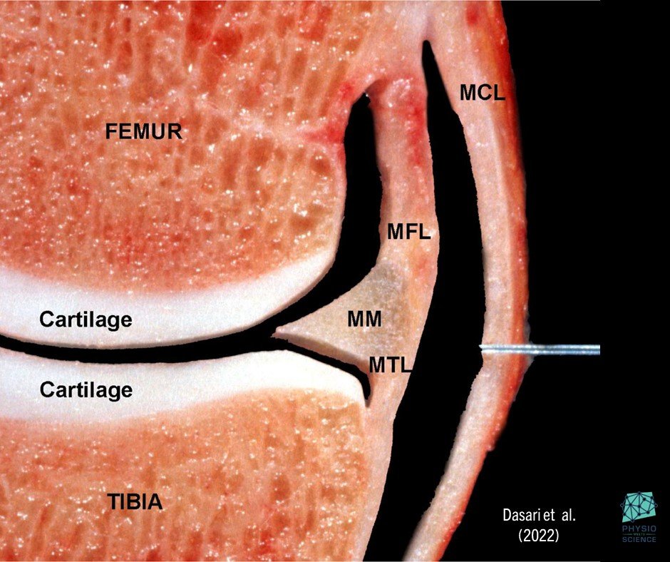 PhysioMeScience's tweet image. the beauty of anatomy 😍

A coronal cross-section of a right knee demonstrating the medial meniscus (MM), the menisco-femoral ligament (MFL), the menisco-tibial ligament (MTL), and the medial collateral ligament (MCL)

sciencedirect.com/science/articl…