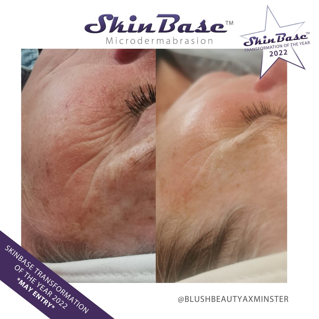 SkinBase_facial's tweet image. ⭐️ May transformation with this fabulous entry from Blush Beauty &amp;amp; Aesthetics. These fantastic results were achieved through a 4 treatment course of Microdermabrasion.

Click the link in our bio for your chance to Win a Holiday! #skinbase #microdermabrasion #transformation22