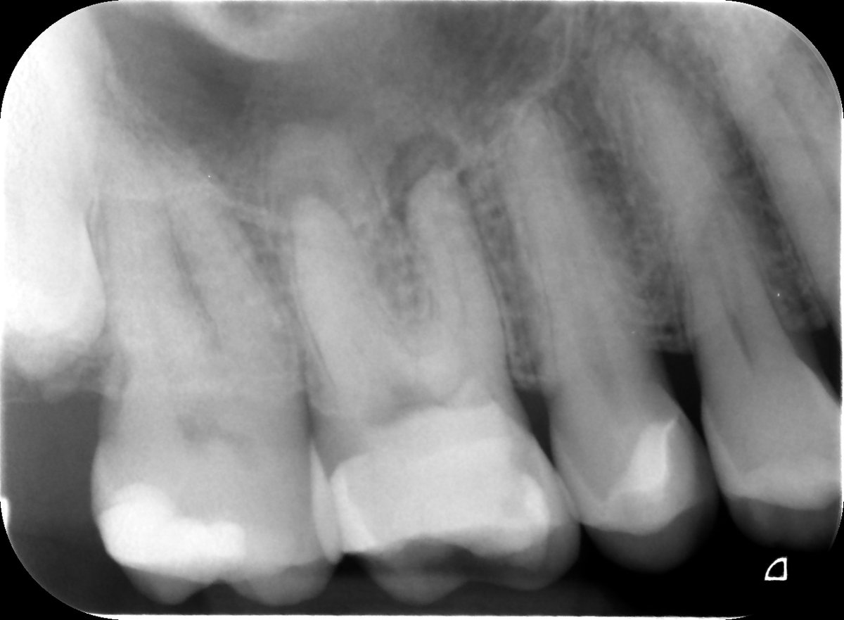 johnrhodesendo's tweet photo. Happy Days in Endoland Saturday Surgery and saving teeth 🤣 UR6 referred for endo after difficulty finding canals. 5 canals in total, EdgeOne Fire preps. Onlay required. Review in 9 months. #savingteeth #endodontics https://t.co/zltNeoc47q