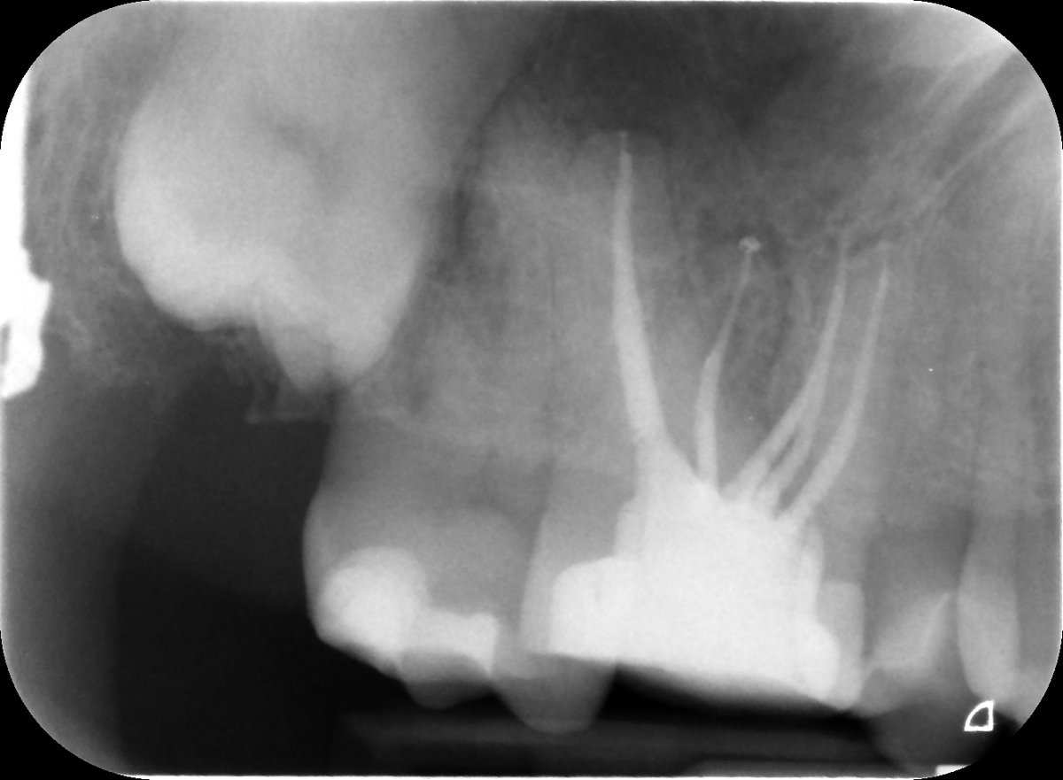Happy Days in Endoland Saturday Surgery and saving teeth 🤣 UR6 referred for endo after difficulty finding canals. 5 canals in total, EdgeOne Fire preps. Onlay required. Review in 9 months. #savingteeth #endodontics