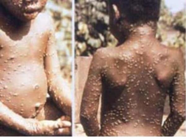 TraderAT12's tweet photo. 🔴#Monkeypox  -Maymun çiçeği virusu 

●Adı böyle olsada konu maymunlardan çok, geçiş yolu olan özellikle bazı sincap türleri ve sıçanlarla ilgili İDİ..!
●Virus yeni değil,yıllardır görülür ve bilinen 2 kolu var.  Batı Afrika ve Orta Afrika kolu
●Batı Afrika kolu ölüm oranı %1 https://t.co/cu0cND6XSy