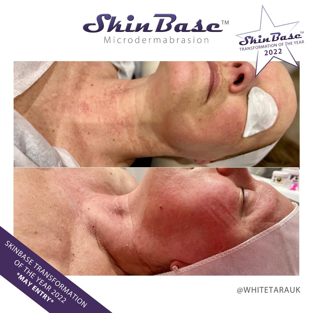 SkinBase_facial's tweet image. ⭐️ May transformation with this fabulous entry from White Tara Health &amp;amp; Beauty. These fantastic results were achieved through a 6 treatment course of Microdermabrasion.  

Click the link in our bio for your chance to Win a Holiday! #skinbase #microdermabrasion #transformation22