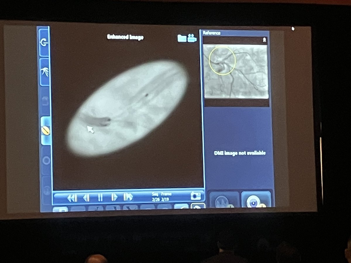 Congrats 👏👏👏<a href="/mirvatalasnag/">MIЯVΛƬ #IC ༄ ｡°</a> for excellent live case demonstration of #atherectomy #orbital #imaging #OCT with amazing results in short time 👍🏽👍🏽#SCAI2022 <a href="/SCAI/">SCAI</a> <a href="/SCAI_WIN/">Women in Innovations</a> <a href="/ArasiMaran/">Arasi Maran</a> <a href="/Pooh_Velagapudi/">Poonam Velagapudi</a> <a href="/Allison_Dupont/">Allison Dupont, MD</a> <a href="/JDawnAbbott1/">J Dawn Abbott</a> <a href="/Hragy/">Hany Ragy</a> <a href="/DocSavageTJU/">Michael Savage</a> <a href="/chadialraies/">Chadi Alraies, MD FACC FSCAI</a> <a href="/SVRaoMD/">Sunil V. Rao</a>