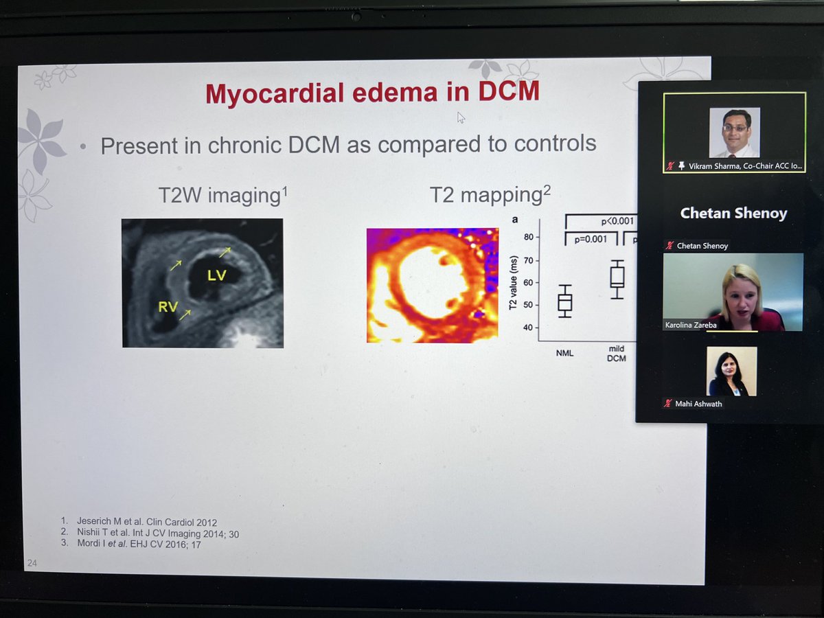 Dr. Zareba delivering a very high yield talk on cardiac MRI in non ischemic cardiomyopathy. Please join us via the link below : iowaacc.org/Advanced-Imagi…