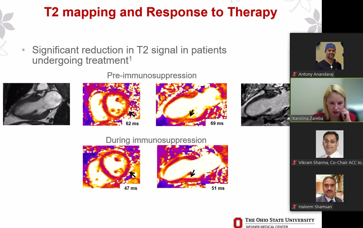 Great talk on CMR in Non-ischemic cardiomyopathy by Dr. Zareba #KarolinaZareba. Stay tuned and feel free to ask any question at the zoom chatbox.
#IowaACCLectures #ACCFIT #ACCEarlyCareer #letslearncardiology
<a href="/ACCinTouch/">American College of Cardiology</a>
<a href="/SCMRorg/">Society for Cardiovascular Magnetic Resonance</a>
<a href="/Heart_SCCT/">Heart_SCCT</a>