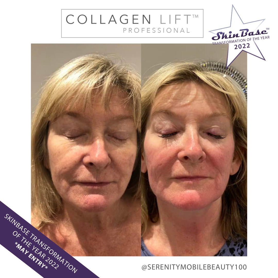 SkinBase_facial's tweet image. ⭐️ May transformation with this fabulous entry from Serenity Beauty. These fantastic results were achieved through a treatment course of Collagen Lift.  

Click the link in our bio for your chance to Win a Holiday! #skinbase #collagenlift #transformation22