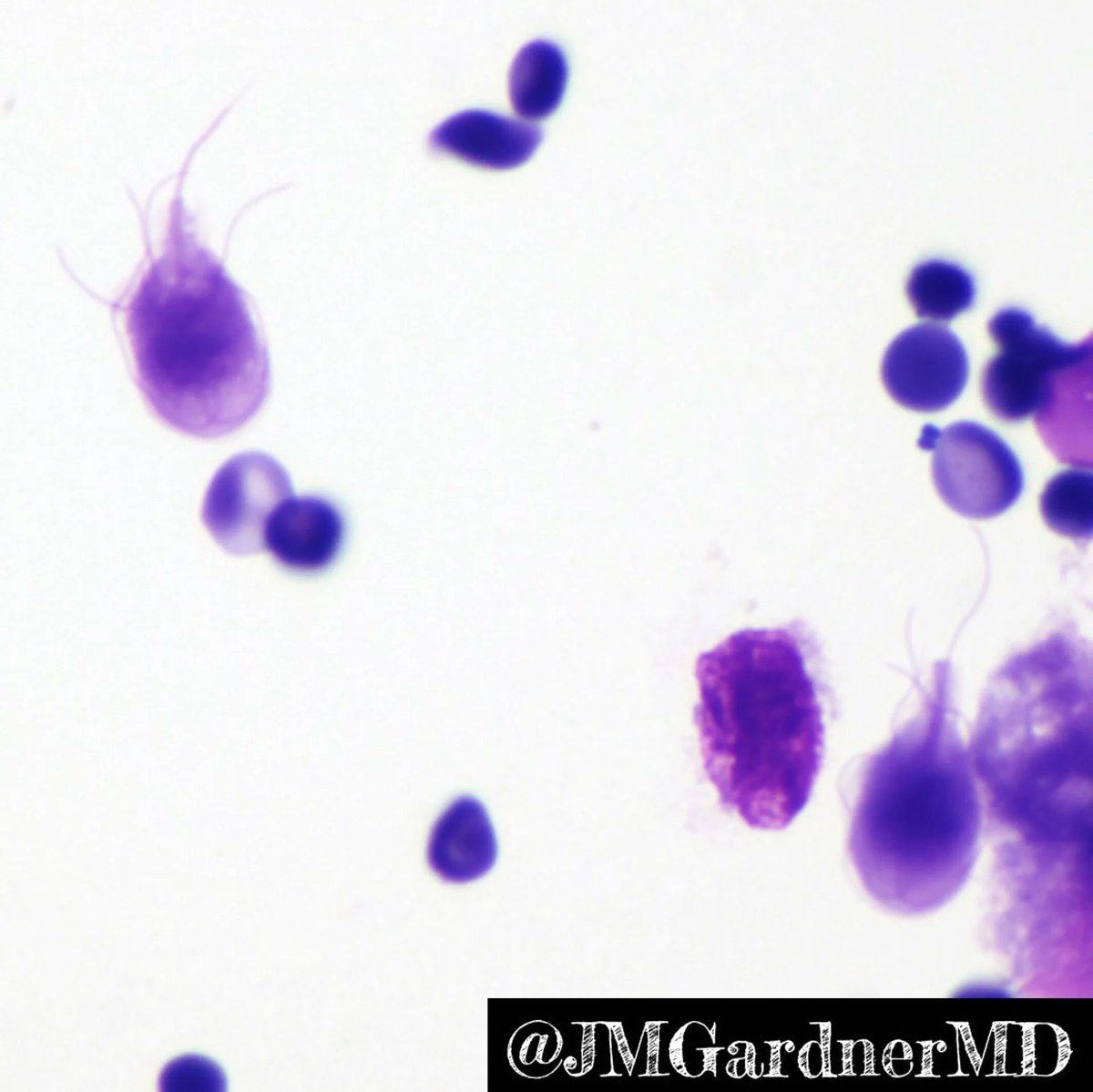 JMGardnerMD's tweet photo. Cytospin #cytology prep of formalin from a small intestine biopsy bottle. Your diagnosis? Answer: https://t.co/kdzJDNIfJy. #GIpath #pathologists #pathology #pathTwitter #IDpath #parasitology https://t.co/bysIu8qUaM