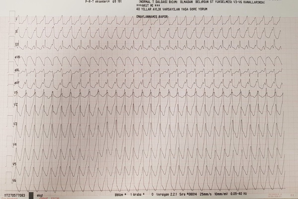 tgkdeniz58's tweet photo. 66 y, F, AVR and MVR 6 years ago,  VT and multiple ICD shocks, refractory to medication.
Access for LV provided by Gerbode defect(RA-LV).
Thanks for introduction of LV access by gerbode @Dr_Santangeli and great support for @taylanakgun.
@BiosenseWebster , #ablateVT, #epeeps,#ICE https://t.co/CazJ2RXJzO
