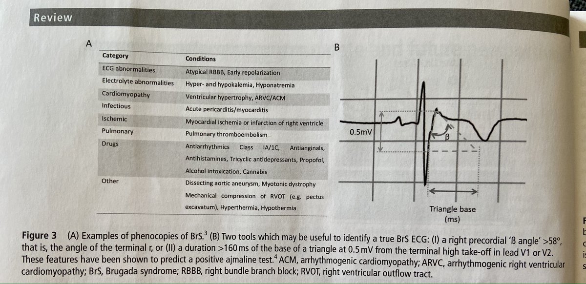 Followed by a useful update on Brugada by <a href="/CarolRemme/">Carol Ann Remme</a> &amp; colleagues. <a href="/Heart_BMJ/">Heart_BMJ</a>  #CardioEd #cardiotwitter #EPeeps 
heart.bmj.com/content/108/9/…

<a href="/DrMarkMills/">Mark Mills</a> <a href="/SheffieldRhythm/">Dr Andreas Kyriacou Sheffield and Limassol</a> <a href="/Dr_GwilymMorris/">Gwilym Morris</a> <a href="/drrichardtill/">Richard Till</a>