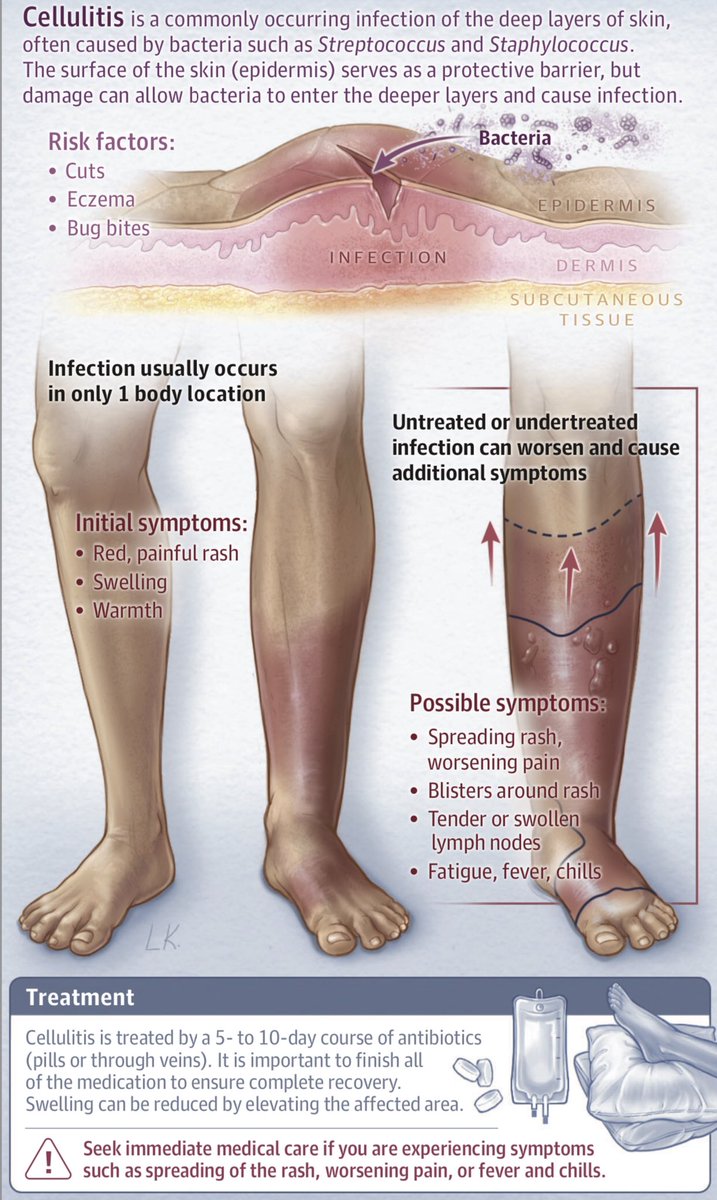 AmbrizMau's tweet photo. Celulitis (información para el paciente):

JAMA Dermatology 2020; DOI: 10.1001/jamadermatol.2020.2083 https://t.co/PAgTY5DIBn