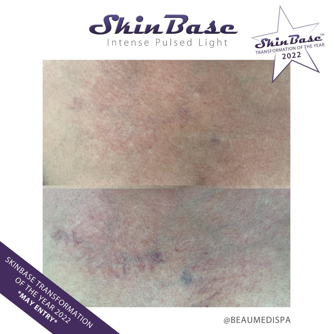 SkinBase_facial's tweet image. ⭐️ May transformation with this fabulous entry from Beau Medispa

These fantastic results were achieved through a 6 treatment course of IPL.  

Click the link in our bio for your chance to Win a Holiday! #skinbase #skinbaseipl #transformation22