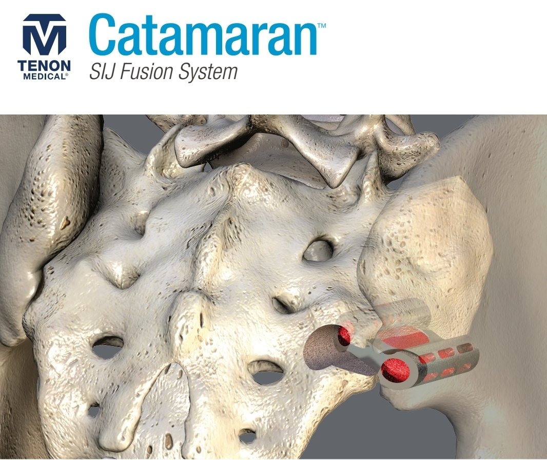 The password is #TRANSFIX

The unique, patented design of the CATAMARAN™#SIJ Fixation Device offers a posteroinferior approach to the #SIJoint using just one titanium implant to transfix the sacrum to the ilium, joined by an autograft-filled osteotome bridge.
#sacroiliacjoint