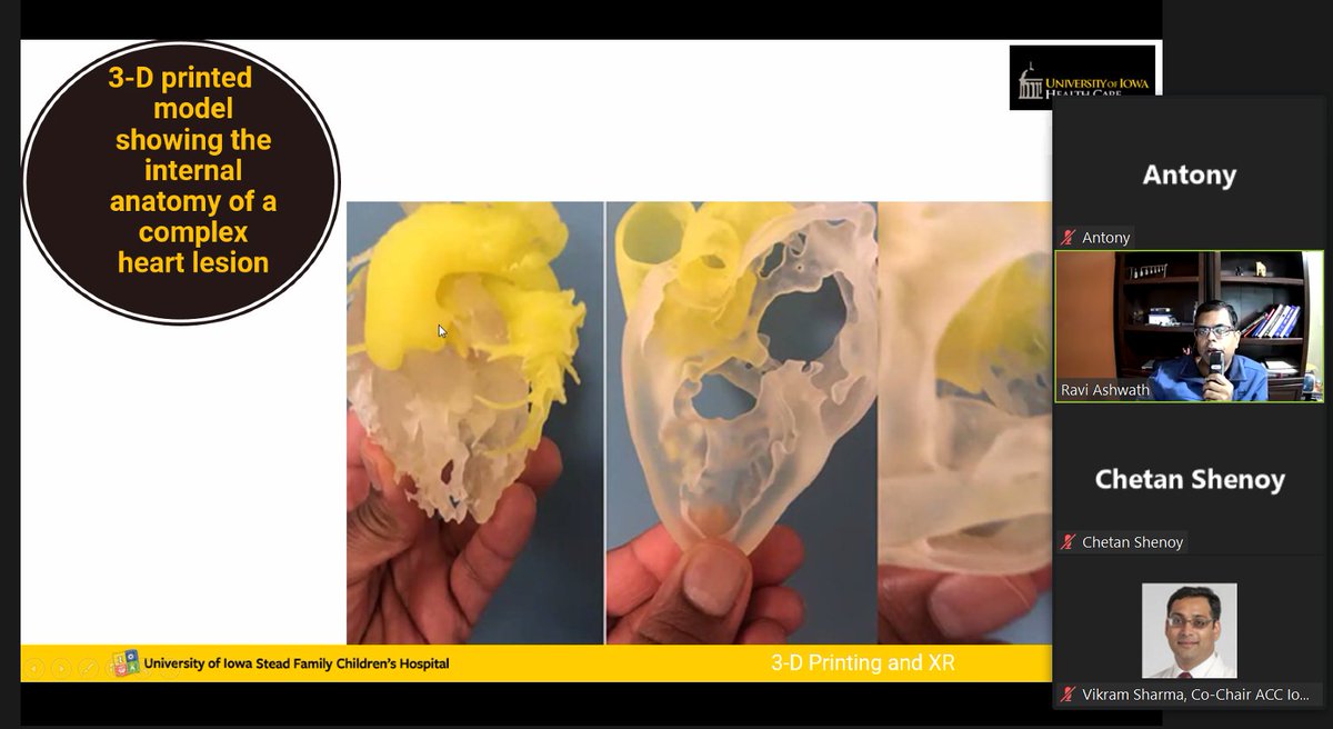 Utility of 3-D printing in patients with complex congenital heart disease <a href="/RaviAshwath1/">Ravi Ashwath</a> 
#IowaACCLectures #ACCFIT #ACCEarlyCareer #letslearncardiology
<a href="/ACCinTouch/">American College of Cardiology</a>
<a href="/SCMRorg/">Society for Cardiovascular Magnetic Resonance</a>
<a href="/Heart_SCCT/">Heart_SCCT</a>