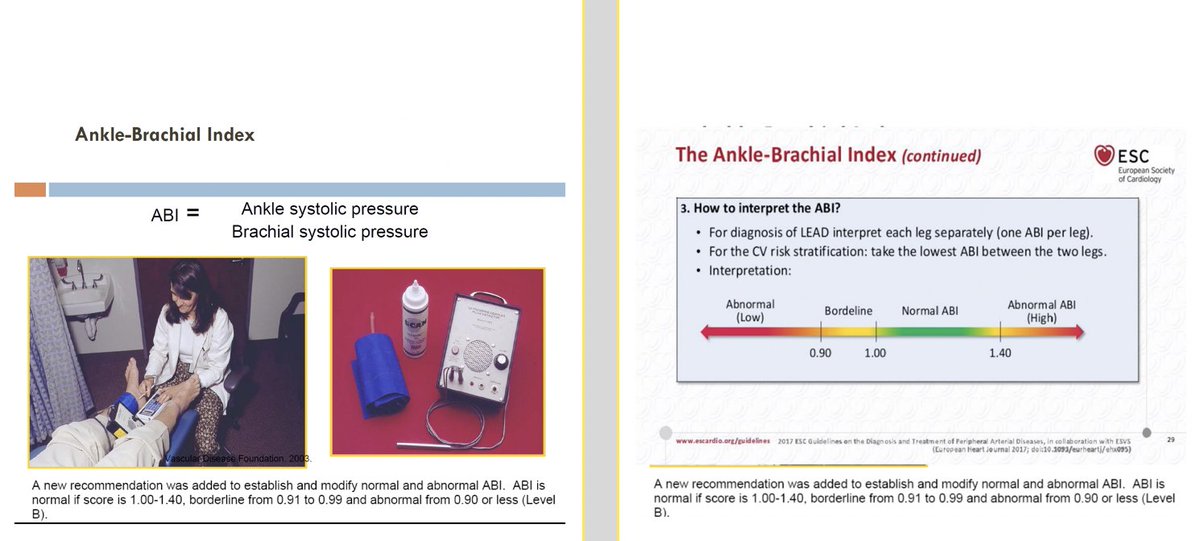 Excellent description of performing ABI by <a href="/JohnPCooke1/">John P. Cooke MD PhD</a> in patients with PAD! 

📌 Use hand-held dopplers, not a stethoscope for this test
📌 Ankle (Posterior tibial artery) systolic pressure / Brachial artery systolic pressure

#CNC2022 #PAD #ABI <a href="/HMethodistCV/">Houston Methodist CV</a>