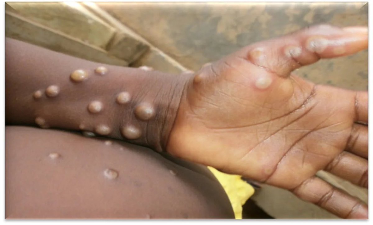 begottensun's tweet photo. All @BBCBreaking &amp; @BBCWorld &amp; @BBCNews icons of “Monkey Pox” have a picture of a Black kid. In the UK only 3% of the population is Black… so is it a Black virus?? https://t.co/lbg4jKx1UU
