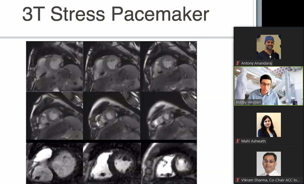 Stay tuned for this Impressive talk on Stress Cardiac MRI- Dr. Heydari #BobbyHeydari
#IowaACCLectures #ACCFIT #ACCEarlyCareer #letslearncardiology
<a href="/ACCinTouch/">American College of Cardiology</a>
<a href="/SCMRorg/">Society for Cardiovascular Magnetic Resonance</a>
<a href="/Heart_SCCT/">Heart_SCCT</a>