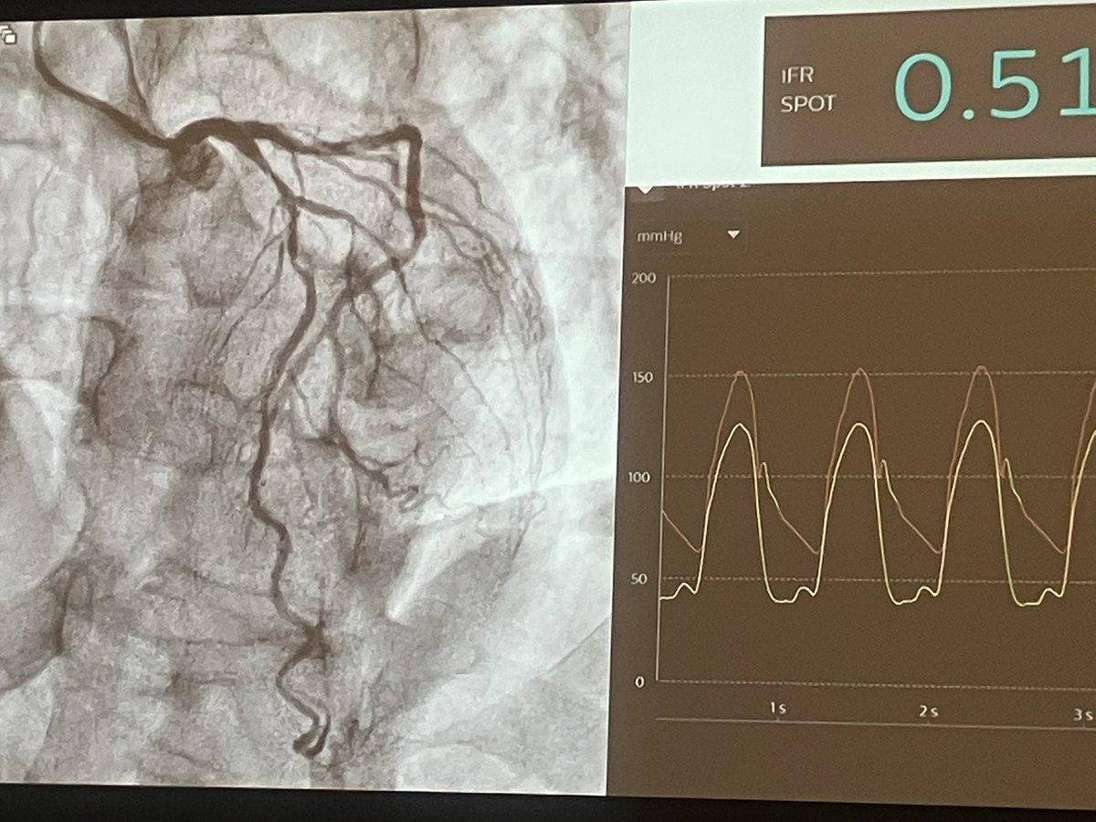 SriPittaMD's tweet photo. #SCAI2022 @SCAI Tips &amp;tricks for #orbital #atherectomy to reduce slow flow, complications perforation, dissection 
>slow speed
>slow run
>short run
>high speed only for large vessels and denseclacium area @kjkunkelmd @SCAI_WIN @KaulP @agtruesdell @ArasiMaran @Pooh_Velagapudi https://t.co/SeDIMH00r7