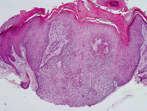 Drmerm's tweet photo. Trichilemmoma
lobular endophytic proliferation composed of uniform basaloid cells with peripheral palisading and clear cell cytoplasm
The cells at the periphery of tumor lobules are more basophilic arranged in a palisading and are surrounded by a thick eosinophilic basal membrane https://t.co/05GwtgXnbd