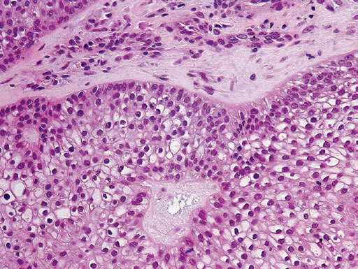 Drmerm's tweet photo. Trichilemmoma
lobular endophytic proliferation composed of uniform basaloid cells with peripheral palisading and clear cell cytoplasm
The cells at the periphery of tumor lobules are more basophilic arranged in a palisading and are surrounded by a thick eosinophilic basal membrane https://t.co/05GwtgXnbd