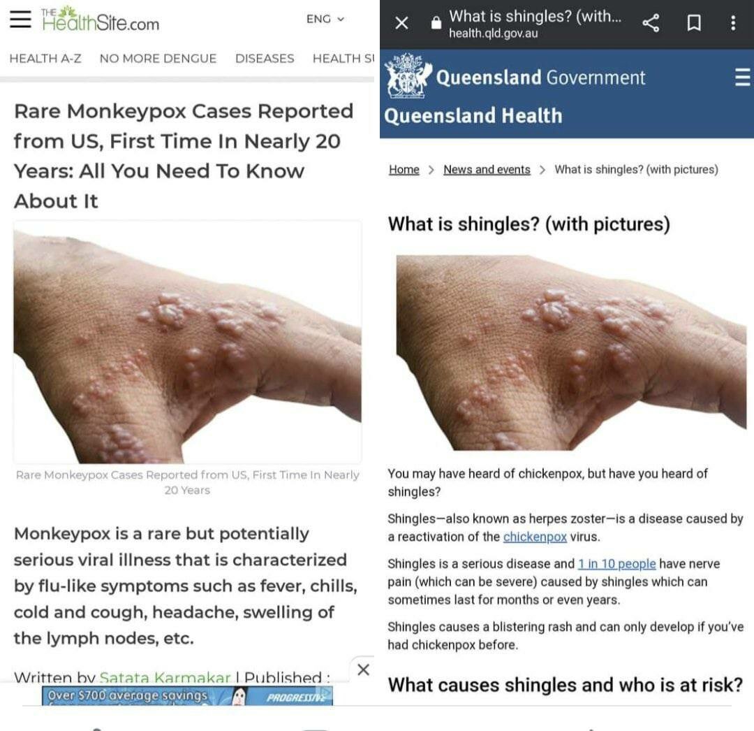 Aceso76's tweet photo. @njboddy Exactly, it's shingles. The immunocompromised get shingles. The vaccine compromises the immune system. No conspiracy, just connecting the dots. https://t.co/XjBFRpjhHs