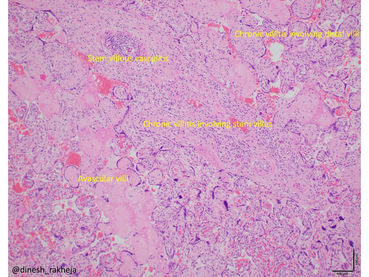 dinesh_rakheja's tweet photo. Villitis of unknown etiology #VUE (should that name become obsolete and changed to something like Immune villitis?); maternal immune cells rejecting placenta; #PediPath #PlacentaPath; #Pathology #PathResidents @UTSW_Pathology @UTSW_PediPath https://t.co/j3gJBjAOLF