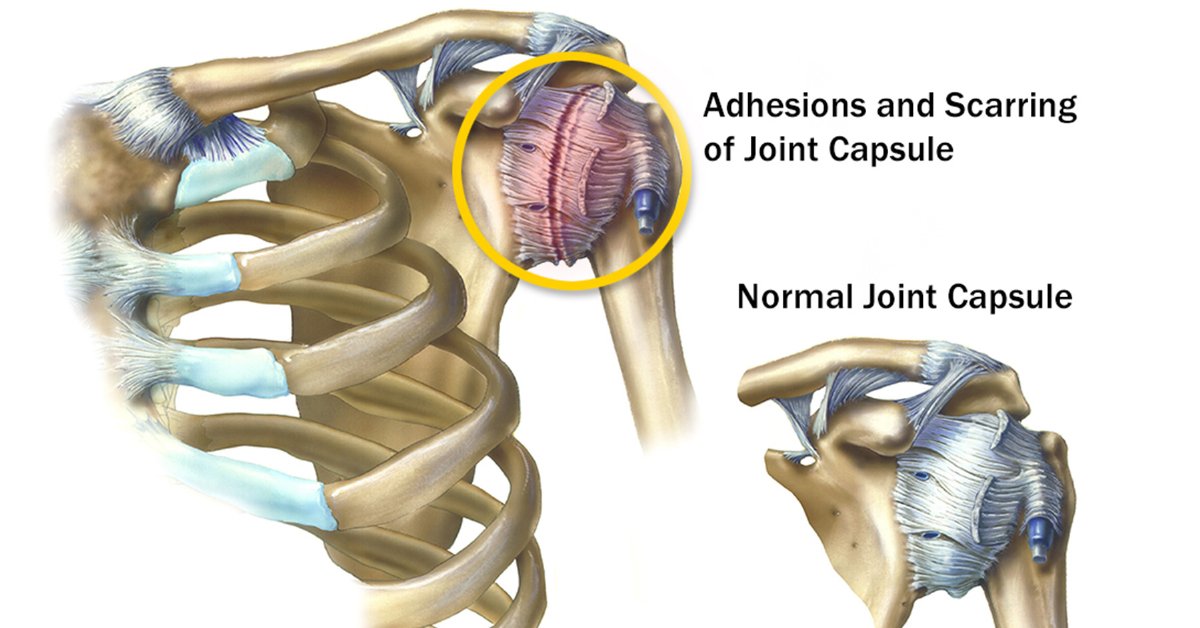 Как лечить капсулит. Адгезивный капсулит плеча. Адгезивный капсулит плечевого сустава («замороженное плечо»). Адгезивный (реактивный капсулит). Суставной капсулит плечевого сустава.