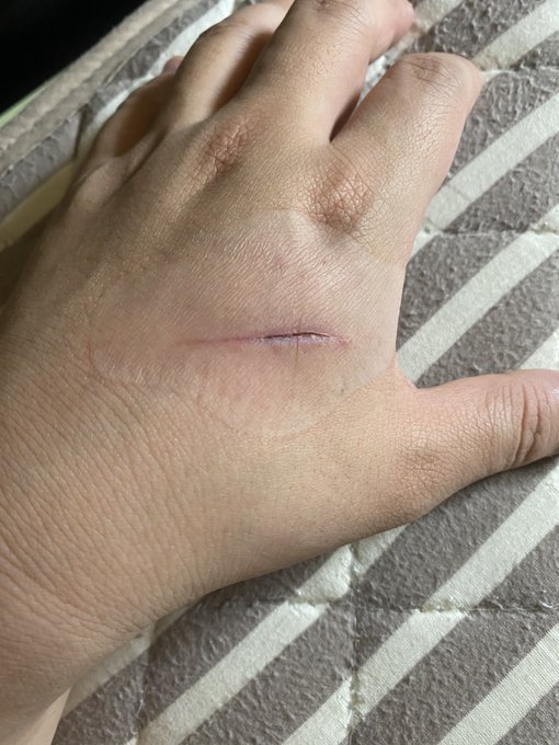 手の甲ザックリと怪我(画像一応注意)して4日目だけど、傷口の確認のためにキズパワーパッド外したら、なんかもうほとんど癒着しててキズパワーパッドすげー!ってなってる…さすが6枚で1000円… 