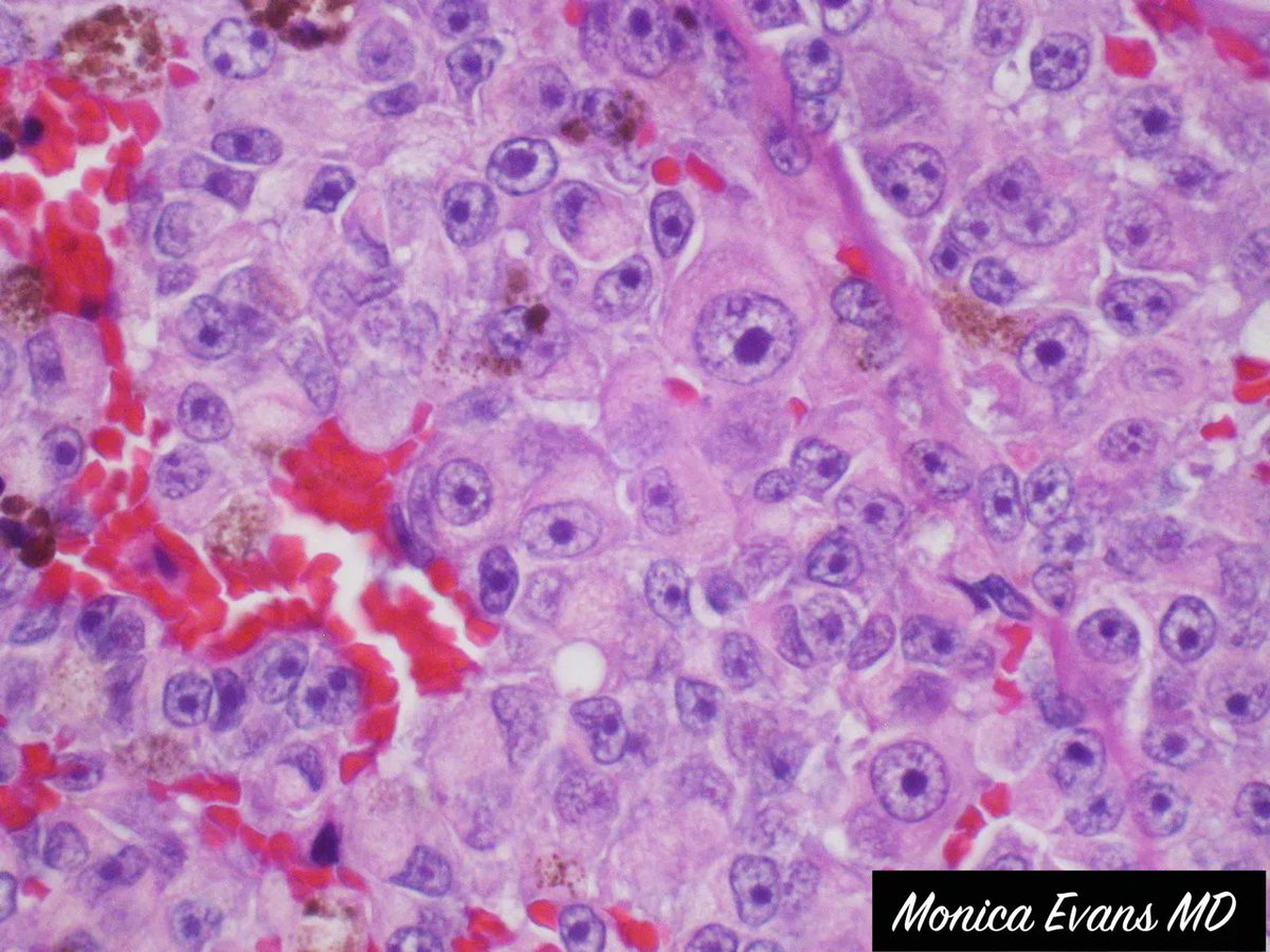 Eye enucleation from an adult. Your diagnosis? Where does it usually metastasize first? Answers: kikoxp.com/posts/5912. Amazing pics by Dr. Monica Evans. #pathologists #pathology #pathTwitter #grosspath #Ophthotwitter #ophtho #MedStudentTwitter #medtwitter <a href="/DGlaucomflecken/">Dr. Glaucomflecken</a>